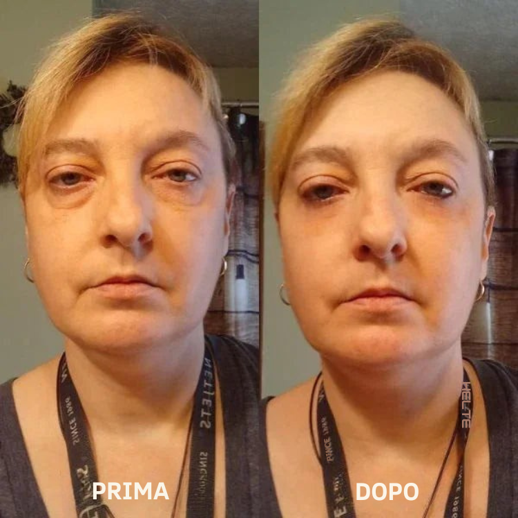 Leviga, rassoda e rimpolpa le zone più difficili con i patch mirati ai Peptidi Aurea