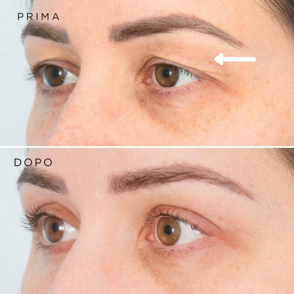 Leviga, rassoda e rimpolpa le zone più difficili con i patch mirati ai Peptidi Aurea