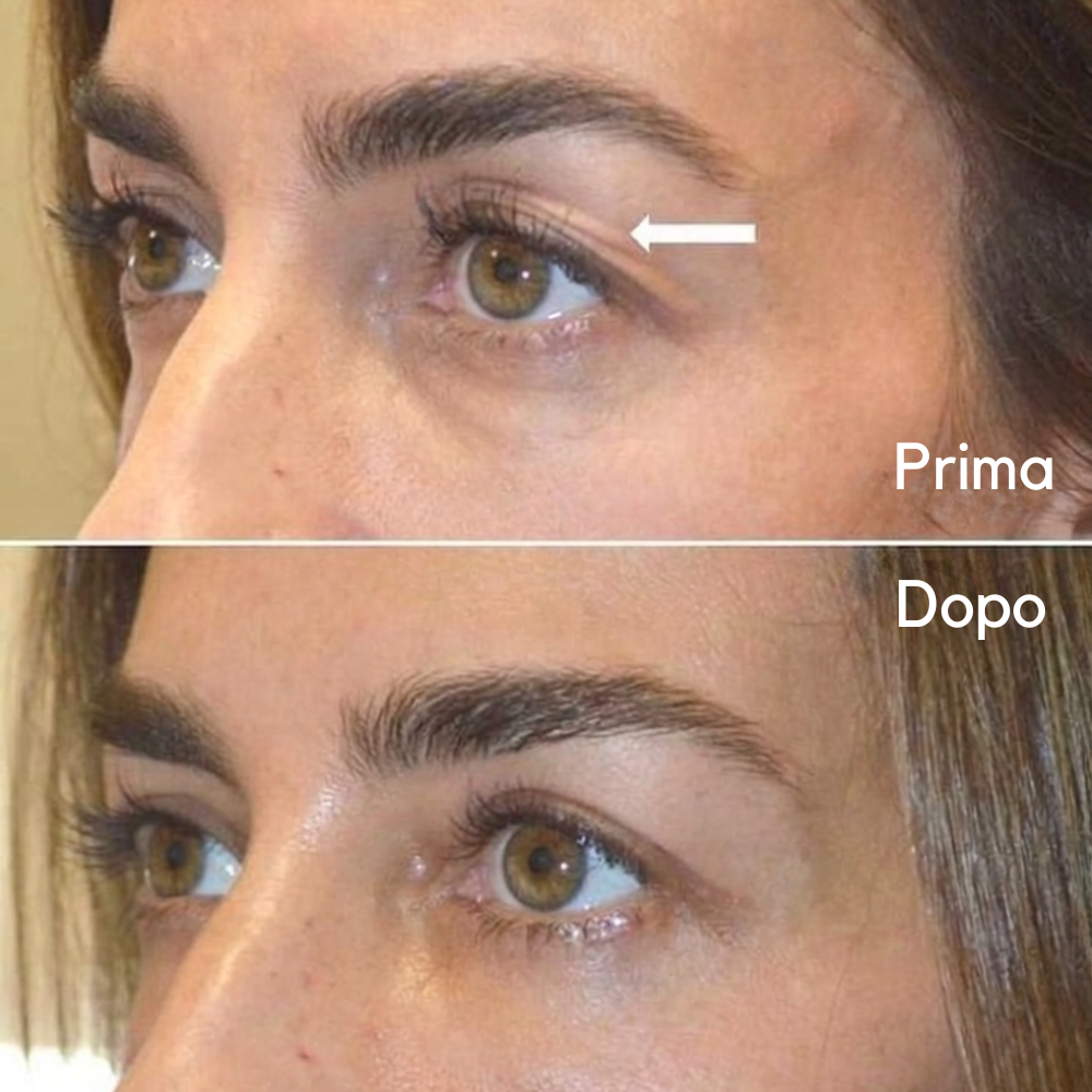 Leviga, rassoda e rimpolpa le zone più difficili con i patch mirati ai Peptidi Aurea